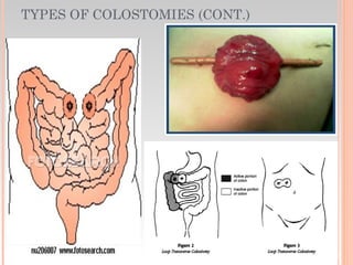 TYPES OF COLOSTOMIES (CONT.)
 Transverse
 