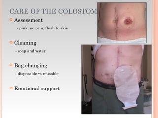 CARE OF THE COLOSTOMY
 Assessment
- pink, no pain, flush to skin
 Cleaning
- soap and water
 Bag changing
- disposable vs reusable
 Emotional support
 