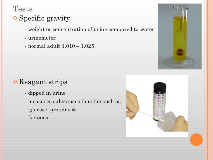 high specific gravity of urine high specific gravity of urine