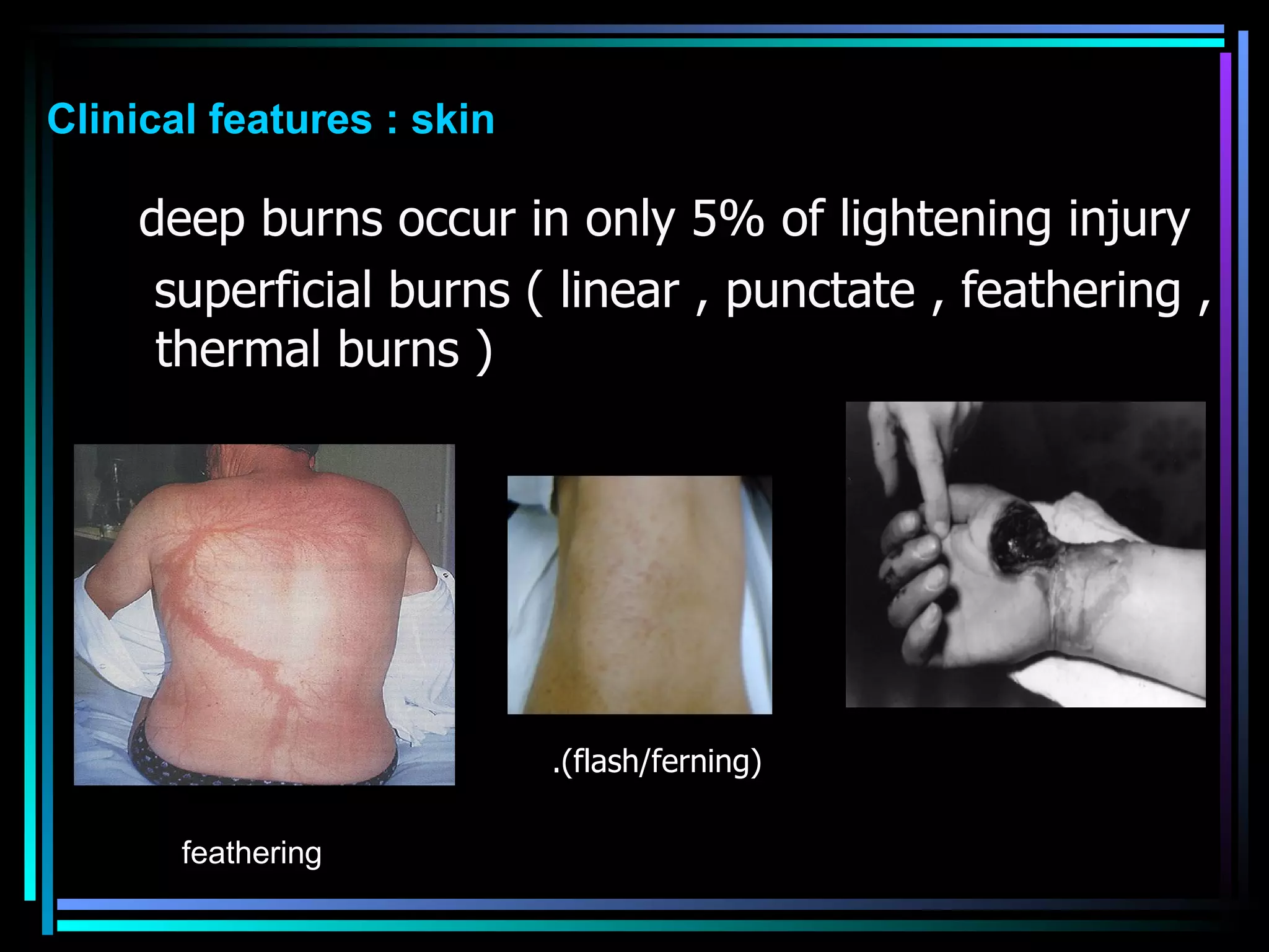 deep burns occur in only 5% of lightening injury  superficial burns ( linear , punctate , feathering , thermal burns )  feathering Clinical features : skin (flash/ferning). 