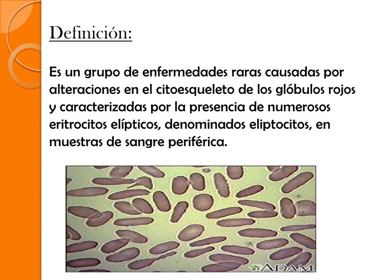 ELIPTOCITOSIS HEREDITARIA PDF