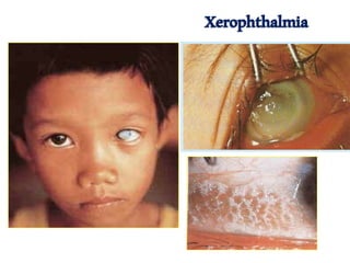 Xerophthalmia
 