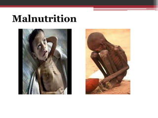 Malnutrition
 