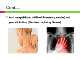 Cont….
 Fatalsusceptibilitytochildhooddiseases(e.g.measles)and
generalinfections(diarrhoea,respiratorydiseases)
 