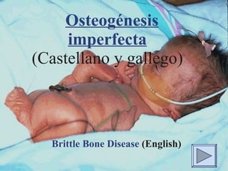 Osteogénesis imperfecta (Castellano y gallego) Brittle Bone Disease   (English) 
