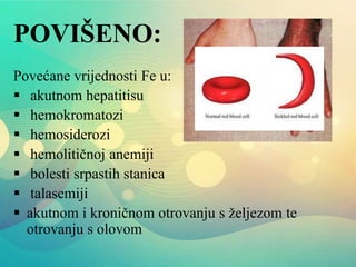 POVIŠENO:
Povećane vrijednosti Fe u:
 akutnom hepatitisu
 hemokromatozi
 hemosiderozi
 hemolitičnoj anemiji
 bolesti srpastih stanica
 talasemiji
 akutnom i kroničnom otrovanju s željezom te
otrovanju s olovom
 