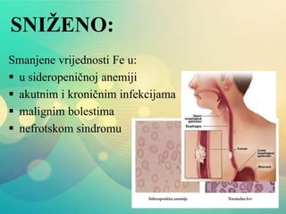SNIŽENO:
Smanjene vrijednosti Fe u:
 u sideropeničnoj anemiji
 akutnim i kroničnim infekcijama
 malignim bolestima
 nefrotskom sindromu
 