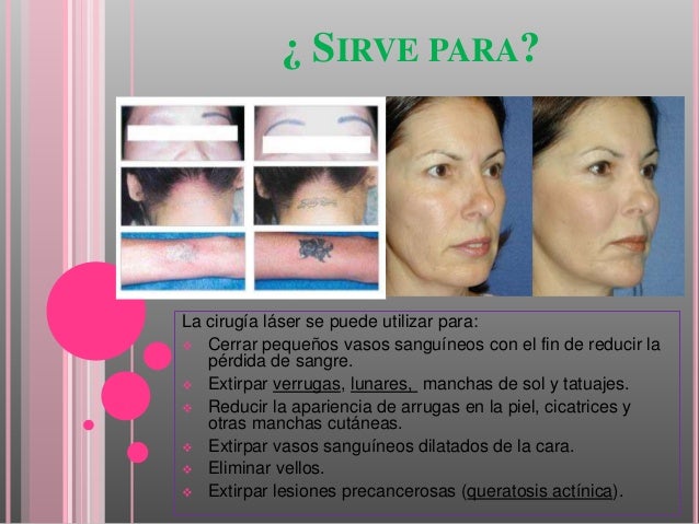 Se puede adelgazar la cara con cirugia