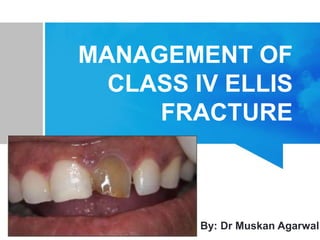 MANAGEMENT OF
CLASS IV ELLIS
FRACTURE
By: Dr Muskan Agarwal
 