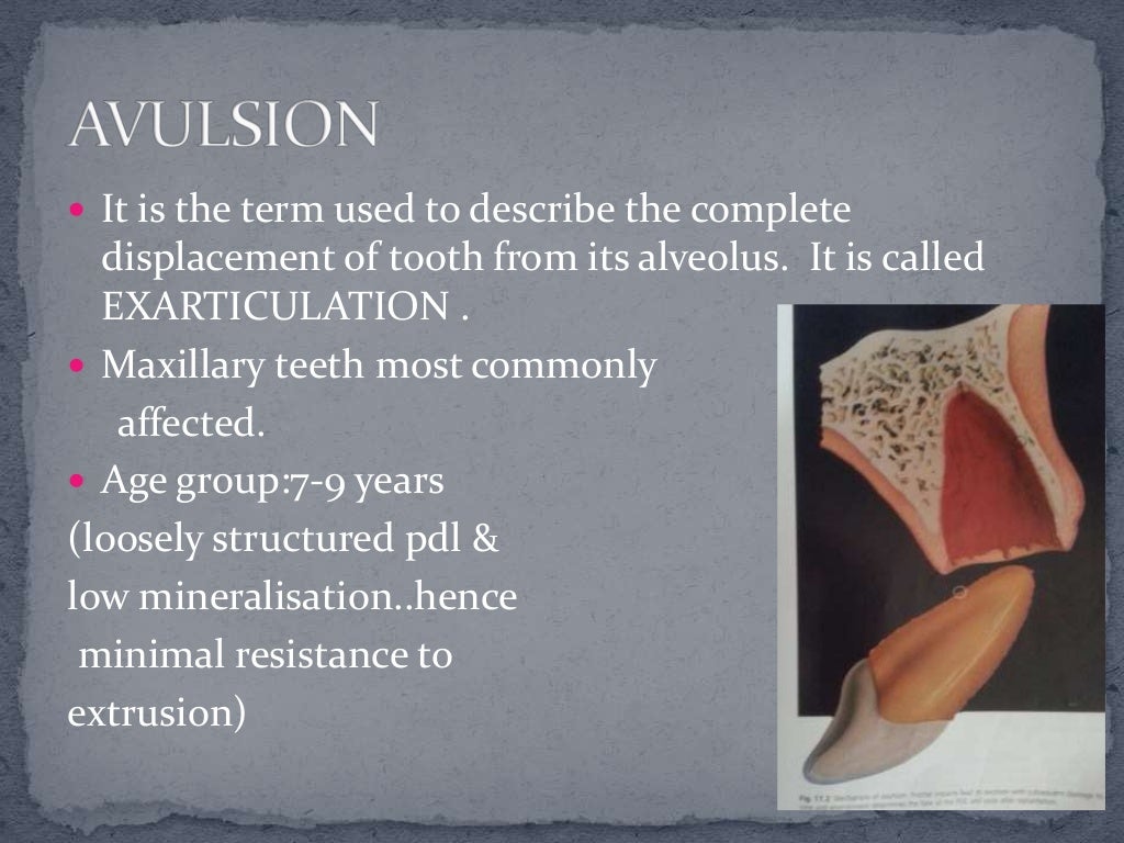 avulsion