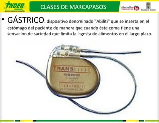 CLASES DE MARCAPASOS

• GÁSTRICO: dispositivo denominado "Abiliti" que se inserta en el
  estómago del paciente de manera que cuando éste come tiene una
  sensación de saciedad que limita la ingesta de alimentos en el largo plazo.
 