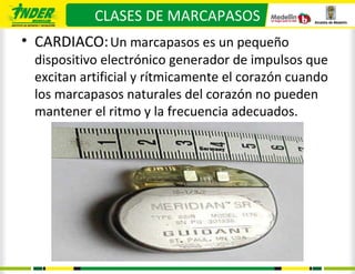 CLASES DE MARCAPASOS
• CARDIACO: Un marcapasos es un pequeño
 dispositivo electrónico generador de impulsos que
 excitan artificial y rítmicamente el corazón cuando
 los marcapasos naturales del corazón no pueden
 mantener el ritmo y la frecuencia adecuados.
 