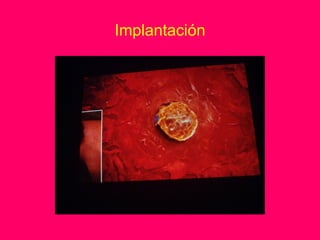 Implantación
 