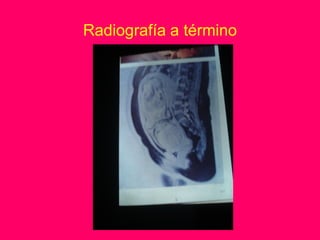 Radiografía a término
 