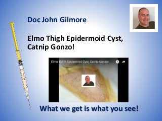 Elmo Thigh Epidermoid Cyst,
Catnip Gonzo!
What we get is what you see!
Doc John Gilmore
 