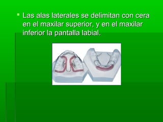  Las alas laterales se delimitan con cera
  en el maxilar superior, y en el maxilar
  inferior la pantalla labial.
 