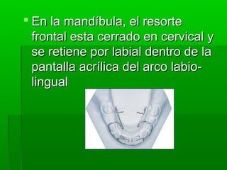  En la mandíbula, el resorte
  frontal esta cerrado en cervical y
  se retiene por labial dentro de la
  pantalla acrílica del arco labio-
  lingual
 