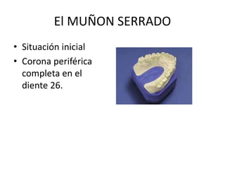 El MUÑON SERRADO
• Situación inicial
• Corona periférica
completa en el
diente 26.
 
