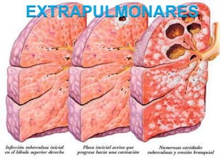 EXTRAPULMONARES
 