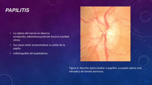 El nervio óptico y su patología.