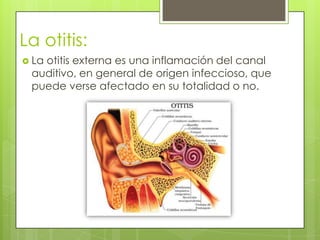 La otitis:
 La

otitis externa es una inflamación del canal
auditivo, en general de origen infeccioso, que
puede verse afectado en su totalidad o no.

 