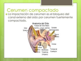 Cerumen compactado

 La

impactación de cerumen es el bloqueo del
canal externo del oído por cerumen fuertemente
compactado.

 