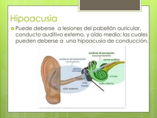 Hipoacusia
 Puede

deberse a lesiones del pabellón auricular,
conducto auditivo externo, y oído medio; las cuales
pueden deberse a una hipoacusia de conducción.

 