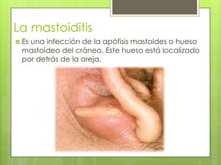 La mastoiditis
 Es

una infección de la apófisis mastoides o hueso
mastoideo del cráneo. Este hueso está localizado
por detrás de la oreja.

 