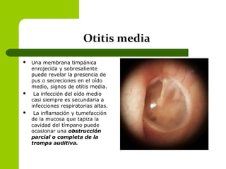 Otitis media
 Una membrana timpánica
enrojecida y sobresaliente
puede revelar la presencia de
pus o secreciones en el oído
medio, signos de otitis media.
 La infección del oído medio
casi siempre es secundaria a
infecciones respiratorias altas.
 La inflamación y tumefacción
de la mucosa que tapiza la
cavidad del tímpano puede
ocasionar una obstrucción
parcial o completa de la
trompa auditiva.
 