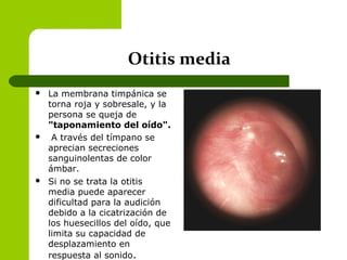 Otitis media
 La membrana timpánica se
torna roja y sobresale, y la
persona se queja de
"taponamiento del oído".
 A través del tímpano se
aprecian secreciones
sanguinolentas de color
ámbar.
 Si no se trata la otitis
media puede aparecer
dificultad para la audición
debido a la cicatrización de
los huesecillos del oído, que
limita su capacidad de
desplazamiento en
respuesta al sonido.
 
