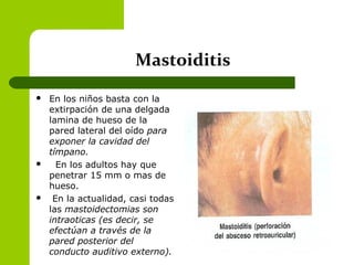 Mastoiditis
 En los niños basta con la
extirpación de una delgada
lamina de hueso de la
pared lateral del oído para
exponer la cavidad del
tímpano.
 En los adultos hay que
penetrar 15 mm o mas de
hueso.
 En la actualidad, casi todas
las mastoidectomias son
intraoticas (es decir, se
efectúan a través de la
pared posterior del
conducto auditivo externo).
 