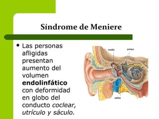 Síndrome de Meniere
 Las personas
afligidas
presentan
aumento del
volumen
endolinfático
con deformidad
en globo del
conducto coclear,
utrículo y sáculo.
 