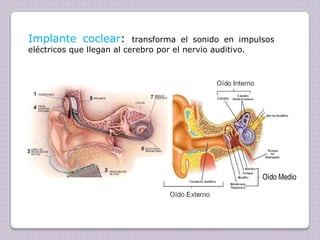 Implante coclear:

transforma el sonido en impulsos
eléctricos que llegan al cerebro por el nervio auditivo.

 
