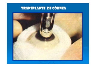 transplante De córnea
 