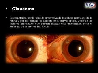 • Glaucoma 
• Se caracteriza por la pérdida progresiva de las fibras nerviosas de la 
retina y por los cambio de aspecto en el nervio óptico. Unos de los 
factores principales que pueden inducir esta enfermedad seria el 
aumento de la presión intraocular. 
 