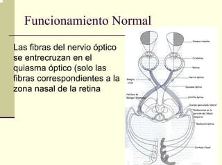 Funcionamiento Normal
Las fibras del nervio óptico
se entrecruzan en el
quiasma óptico (solo las
fibras correspondientes a la
zona nasal de la retina
 