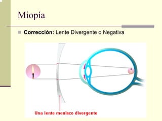 Miopía
 Corrección: Lente Divergente o Negativa
 