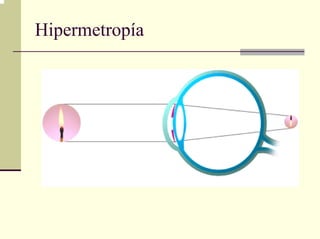 Hipermetropía
 
