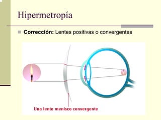Hipermetropía
 Corrección: Lentes positivas o convergentes
 