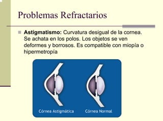 Problemas Refractarios
 Astigmatismo: Curvatura desigual de la cornea.
 Se achata en los polos. Los objetos se ven
 deformes y borrosos. Es compatible con miopía o
 hipermetropía
 