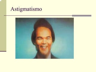 Astigmatismo
 