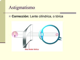 Astigmatismo
 Corrección: Lente cilíndrica, o tórica
 