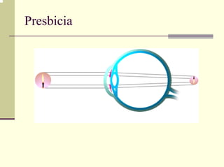 Presbicia
 