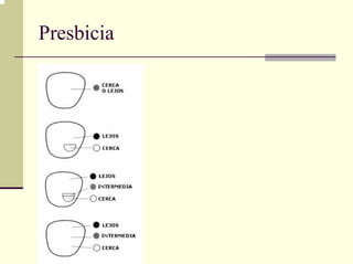 Presbicia
 