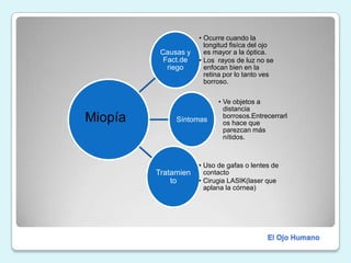MiopíaEl Ojo Humano