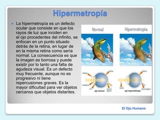                     HipermetropíaLa hipermetropía es un defecto ocular que consiste en que los rayos de luz que inciden en el ojo procedentes del infinito, se enfocan en un punto situado detrás de la retina, en lugar de en la misma retina como sería normal. La consecuencia es que la imagen es borrosa y puede existir por lo tanto una falta de agudeza visual. Es un defecto muy frecuente, aunque no es progresivo ni tiene repercusiones graves. Es la mayor dificultad para ver objetos cercanos que objetos distantes.El Ojo Humano
