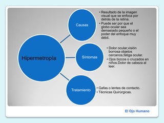 HipermetropíaEl Ojo Humano
