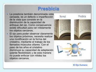                         PresbiciaLa presbicia también denominada vista cansada, es un defecto o imperfección de la vista que consiste en la disminución de la capacidad de enfoque del ojo. Como consecuencia existe dificultad para ver nítidamente los objetos cercanos.