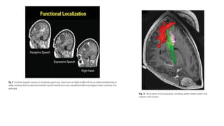 Surgical techiniques in tumors of eloquent areas of brain | PPTX