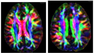 Surgical techiniques in tumors of eloquent areas of brain | PPTX